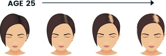 Female Hair Thinning & Hair Loss - Minoxidil Spray