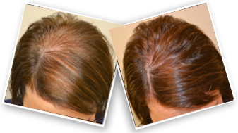 Alorepair VIXA Minoxidil 5% Spray For Hair Loss & Beard Growth + Free Hair  Booster | Jumia Nigeria