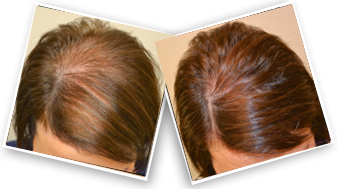 Image result for hair loss treatment Minoxidil