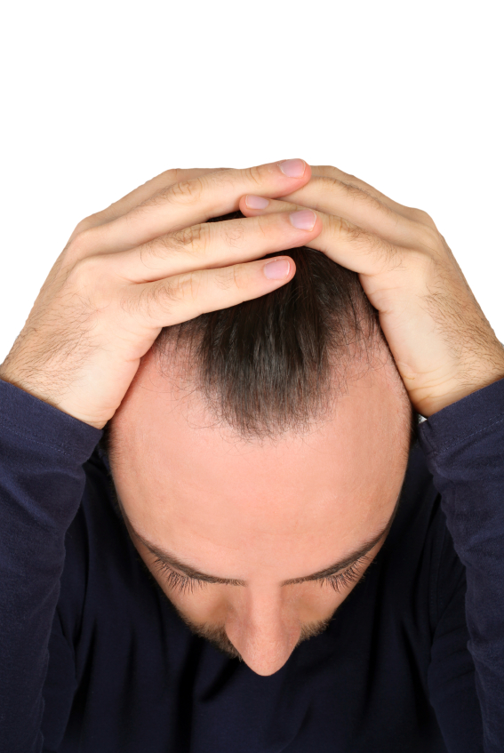 The Definitive Guide to Hair Loss in Men and Thinning Hair in Men