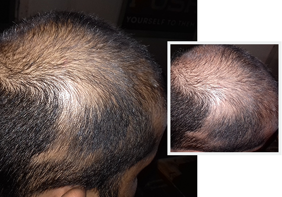 Trinoxxx Minoxidil Hair Growth Spray 60ml | Lazada PH