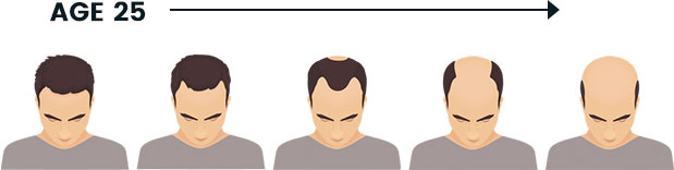 Male and female pattern hair loss Treatable and worth treating  Cleveland  Clinic Journal of Medicine