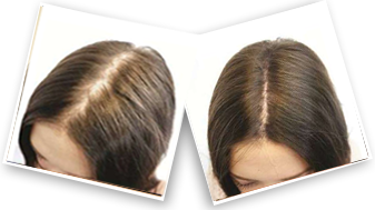 Women's Minoxidil Spray 5% For Hair Loss Treatment | Minoxidil Spray