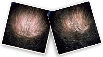 Minoxidil Topical Hair Growth Solution at Best Price in India |  Healthkart.com