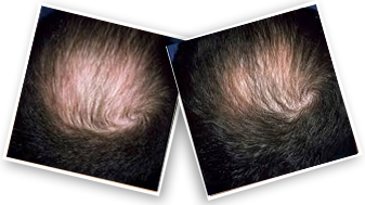 Minoxidil 5% Hair Regrowth Treatment | Minoxidil Spray