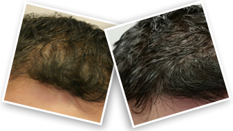 Hair & Beard Growth Spray 100ml With 5% Minoxidil - 99 Rands